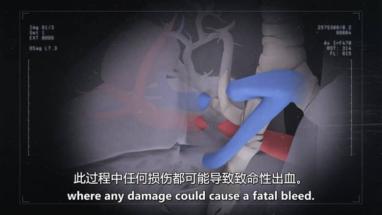 BBC纪录片《外科医生：生命边缘 Surgeons: At the Edge of Life 2024-2025》第6-7季全12集 英语中英双字 官方纯净版 1080P/MKV/38.4G 手术室的故事插图2