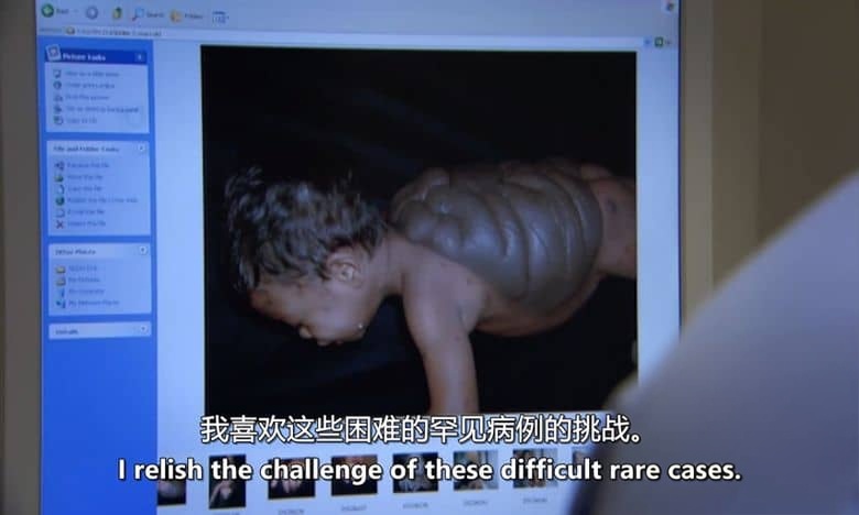 英国纪录片《海龟男孩 Turtle Boy 2023》英语中英双字 无水印纯净版 1080P/MKV/1.92G 罕见疾病插图2