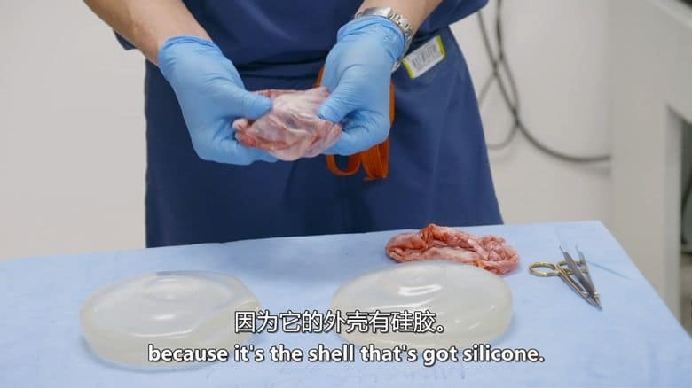 美国纪录片《人体植入物 Explant 2021》英语中英双字 无水印纯净版 1080P/MKV/3.1G 整容植入插图3 美国纪录片《人体植入物 Explant 2021》英语中英双字 无水印纯净版 1080P/MKV/3.1G 整容植入插图3