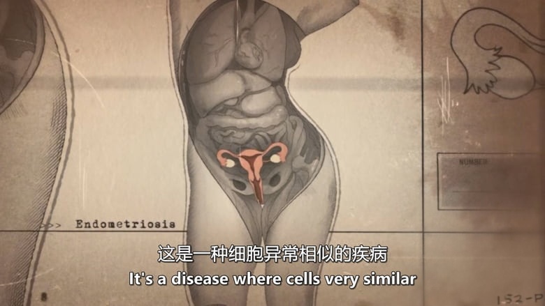 BBC纪录片《艾玛·巴内特:对抗子宫内膜异位症 Emma Barnett: Fighting Endometriosis 2026》英语中英双字 无水印纯净版 社会与医疗问题插图2 BBC纪录片《艾玛·巴内特:对抗子宫内膜异位症 Emma Barnett: Fighting Endometriosis 2026》英语中英双字 无水印纯净版 社会与医疗问题插图2