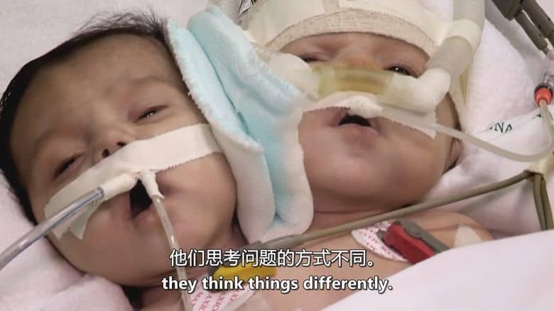 美国纪录片《双头男孩 The Boy with Two Heads 2014》英语中英双字 无水印纯净版插图1