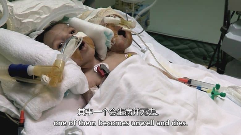 美国纪录片《双头男孩 The Boy with Two Heads 2014》英语中英双字 无水印纯净版插图5