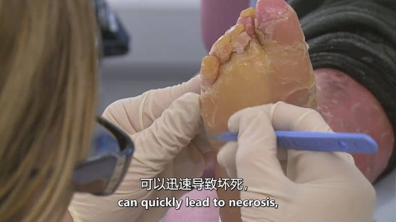 英国纪录片《鱼鳞女奈莉 Nelly the Snakeskin Woman 2017》英语中英双字 无水印纯净版 鱼鳞癣患者插图5 英国纪录片《鱼鳞女奈莉 Nelly the Snakeskin Woman 2017》英语中英双字 无水印纯净版 鱼鳞癣患者插图5