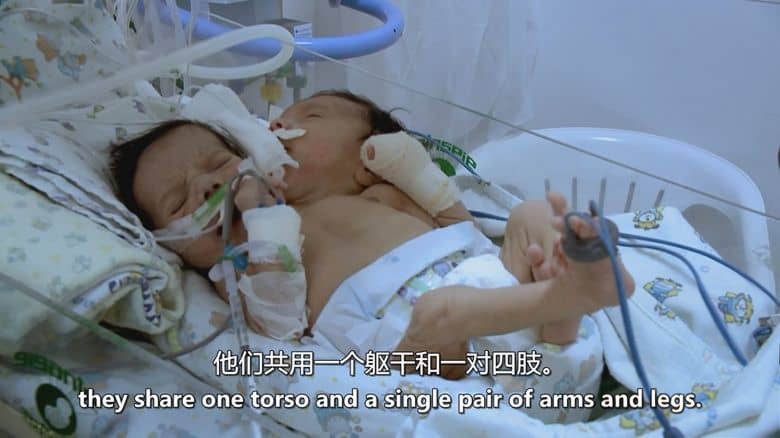 美国纪录片《双头男孩 The Boy with Two Heads 2014》英语中英双字 无水印纯净版插图3