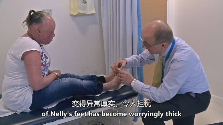 英国纪录片《鱼鳞女奈莉 Nelly the Snakeskin Woman 2017》英语中英双字 无水印纯净版 鱼鳞癣患者插图4 英国纪录片《鱼鳞女奈莉 Nelly the Snakeskin Woman 2017》英语中英双字 无水印纯净版 鱼鳞癣患者插图4