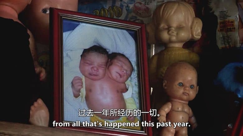 美国纪录片《双头男孩 The Boy with Two Heads 2014》英语中英双字 无水印纯净版插图7