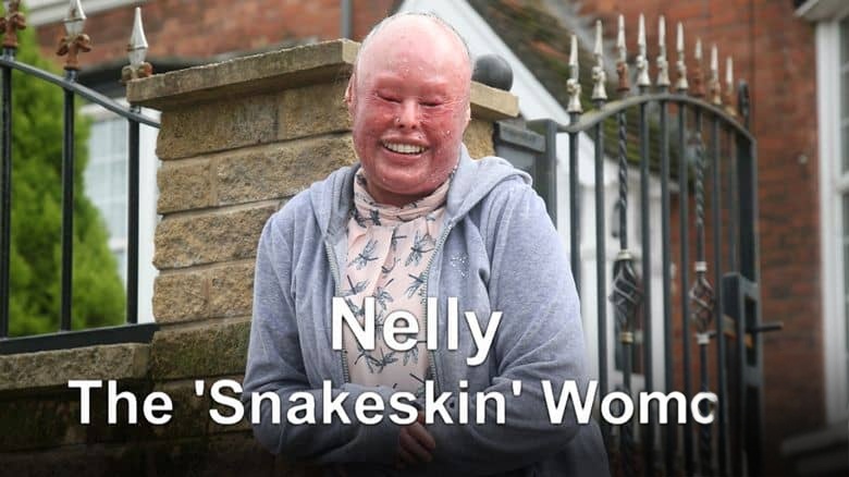 英国纪录片《鱼鳞女奈莉 Nelly the Snakeskin Woman 2017》英语中英双字 无水印纯净版 鱼鳞癣患者插图 英国纪录片《鱼鳞女奈莉 Nelly the Snakeskin Woman 2017》英语中英双字 无水印纯净版 鱼鳞癣患者插图