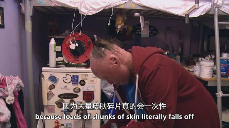 英国纪录片《鱼鳞女奈莉 Nelly the Snakeskin Woman 2017》英语中英双字 无水印纯净版 鱼鳞癣患者插图3 英国纪录片《鱼鳞女奈莉 Nelly the Snakeskin Woman 2017》英语中英双字 无水印纯净版 鱼鳞癣患者插图3