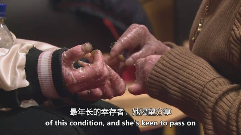 英国纪录片《鱼鳞女奈莉 Nelly the Snakeskin Woman 2017》英语中英双字 无水印纯净版 鱼鳞癣患者插图6 英国纪录片《鱼鳞女奈莉 Nelly the Snakeskin Woman 2017》英语中英双字 无水印纯净版 鱼鳞癣患者插图6
