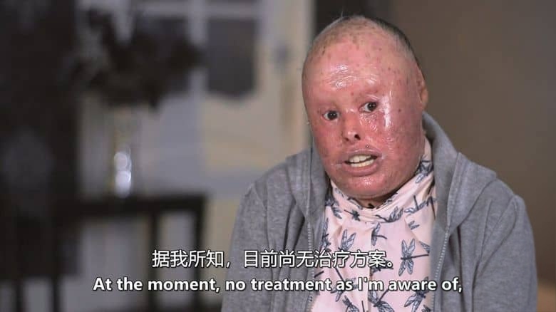 英国纪录片《鱼鳞女奈莉 Nelly the Snakeskin Woman 2017》英语中英双字 无水印纯净版 鱼鳞癣患者插图1 英国纪录片《鱼鳞女奈莉 Nelly the Snakeskin Woman 2017》英语中英双字 无水印纯净版 鱼鳞癣患者插图1